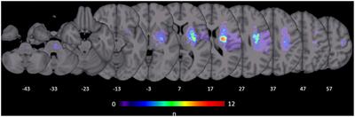 Prefrontal-Premotor Pathways and Motor Output in Well-Recovered Stroke Patients